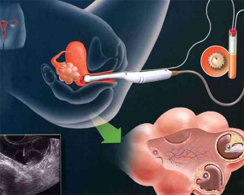 <strong>试管婴儿医院手术费用解析与选择指南</strong>